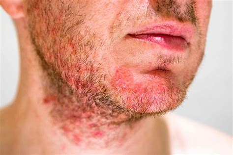Faire face à la dermatite séborrhéique - Fmedic