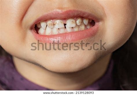 El niño muestra dientes con hipoplasia. Foto de stock 2139128093 ...