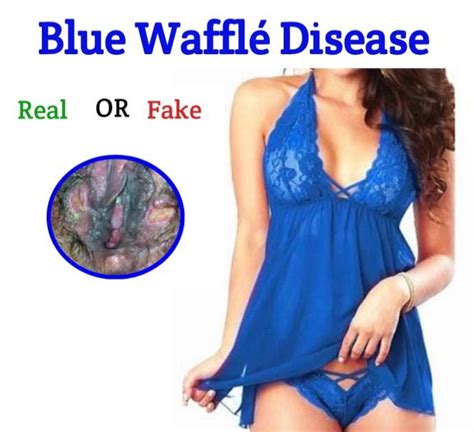 Blue Wafflé Disease: WebMD Separates Facts From Fiction (Pictures ...