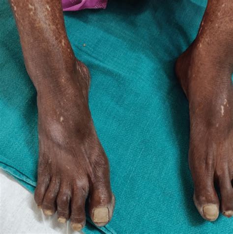 limited cutaneous scleroderma  case report pmc