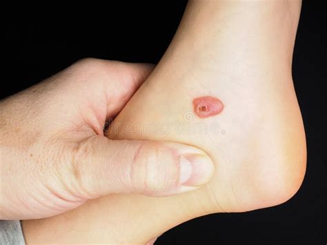 Calo De Sangue No Pé - Bolha de sangue no pé foto de stock. Imagem de posse - 105720960