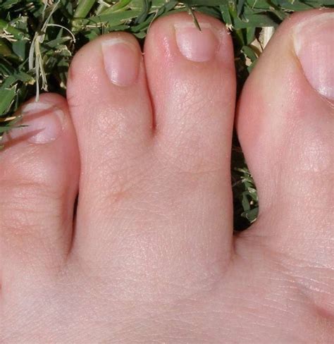 Webbed Fingers And Toes