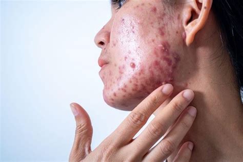 Acne Unveiled: Understanding the Causes and Triggers Behind Breakouts