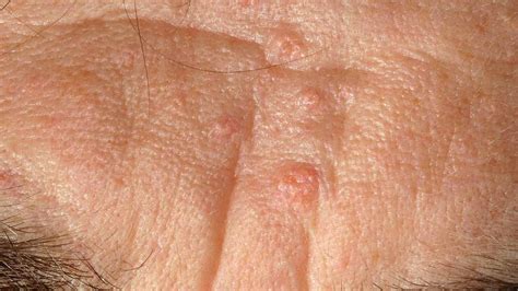 Sebaceous Hyperplasia: Symptoms, Causes, and Treatment