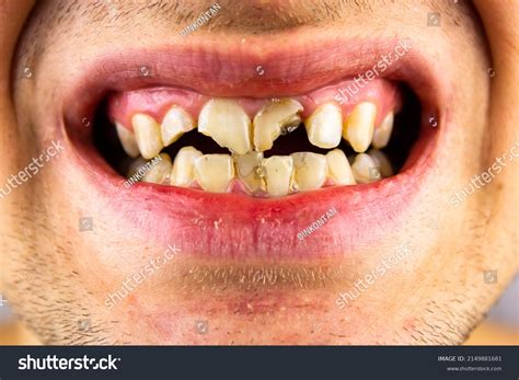 broken teeth closeup broken teeth stock photo  shutterstock