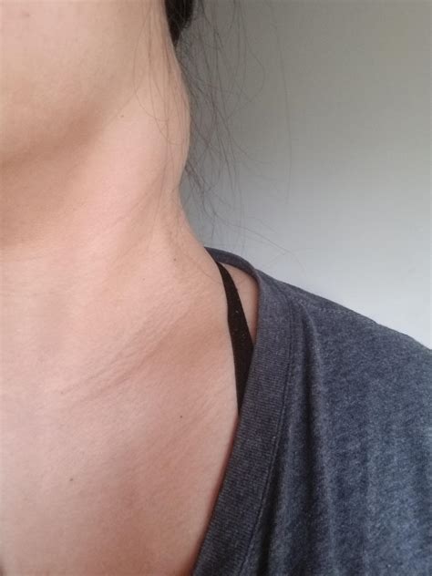Lump On Neck Left Side
