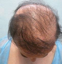 FUE Hair Restoration Cost, Factors in Surgery Pricing