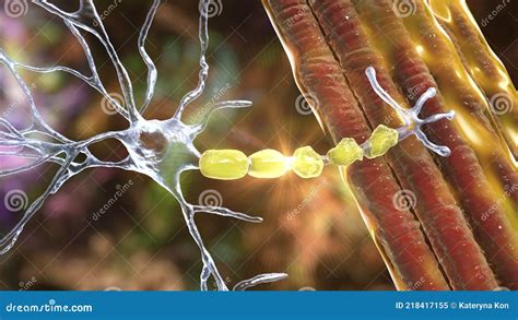 Demyelination of Neuron, the Damage of the Neuron Myelin Sheath Seen in ...