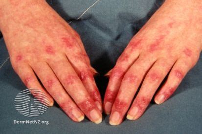 rashes symptoms  treatment cumberland skin