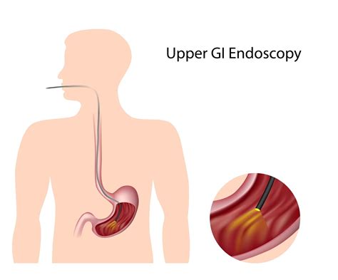 Gi Endoscopy Practice: Upper GI Endoscopy and the Disappearing Barium ...