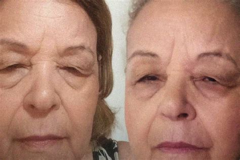 Blefaroplastia A Laser Preço - Transformações antes e depois: resultados reais da blefaroplastia ...