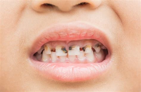 Rotten Teeth In Children Stock Photos, Pictures & Royalty-Free Images ...