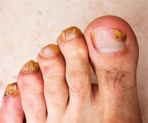 Understanding Foot Fungus: Causes, Symptoms, and Treatment - 365 Script ...