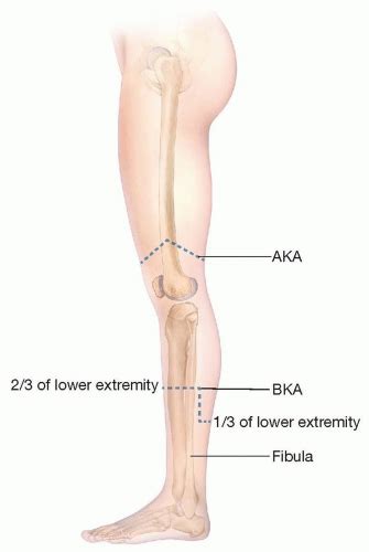 Amputation of the Lower Extremity: Above-Knee Amputation, Below-Knee ...
