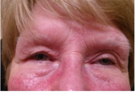 dry eye syndrome windsor dry eye centre