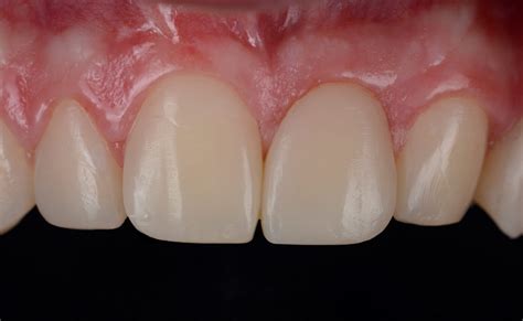 Stabilizing complex cases with single shade composites - Styleitaliano.org