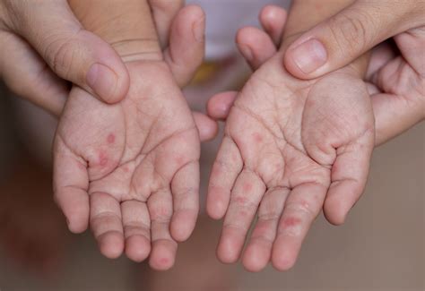 Hånd Fot Og Munnsykdom Eller Vannkopper