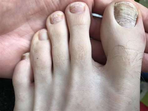 What is this? I thought it was a fungus infection so I sent nail