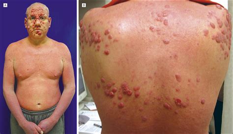 Lymphoma Skin Cancer Symptoms