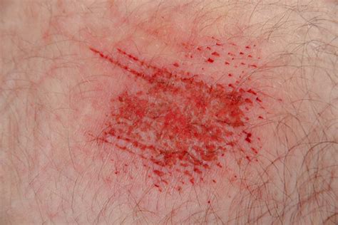 skin abrasions