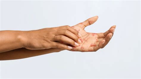 O Que Significa Coceira Na Mão Esquerda - O que significa sentir coceira na mão esquerda