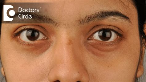 how to get rid of hollow eyes
