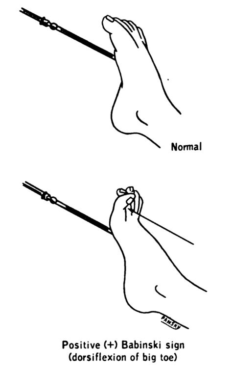 Figure 6.41, [Plantar Reflex and Babinski Sign]. - Nursing Skills ...