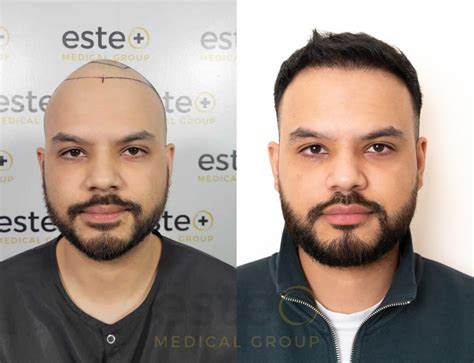 hair transplant    este medical group