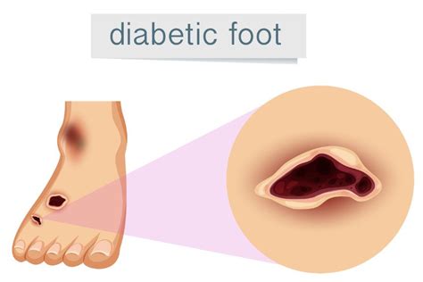 Diabetic Foot Problems: Symptoms, Treatment, and Care