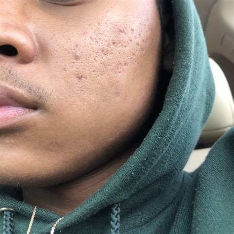 Face Acne Large Pores at Victoria Jenkins blog