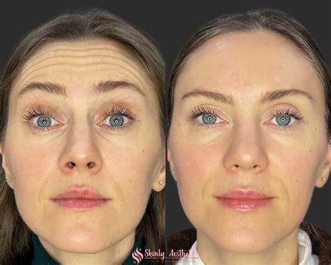 Botox Before and After Results - Everything You Need to See & Know