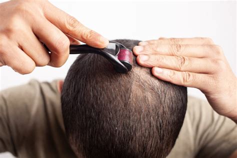 How to Use Dermaroller for Hair Loss: Complete Hair Growth Guide