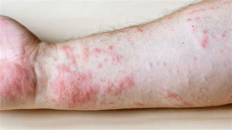 Rash 22 common skin rashes pictures causes treatment – Artofit