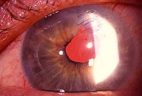 Slit lamp photograph of the eye, one day after traumatic cataract ...