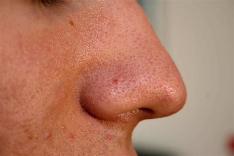 Youtube Blackheads Removal - Surveys Hyatt