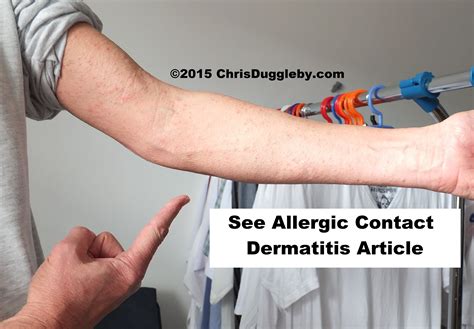 Poison in your Washing Machine: Allergic Contact Dermatitis from