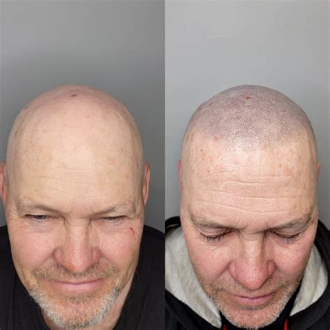 Long-Lasting Scalp Micropigmentation | SKINS Derma Care