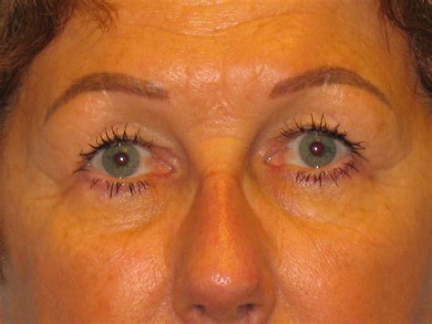 Blepharoplasty Before & After Photos | Myers Plastic Surgery