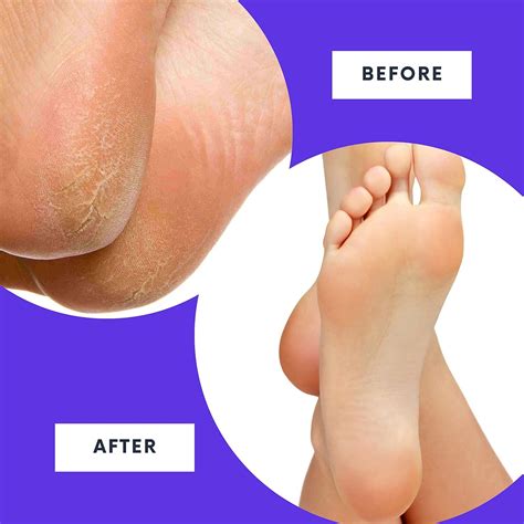RoutineB Callus Remover Gel - Extra Strength Foot Callus Treatment