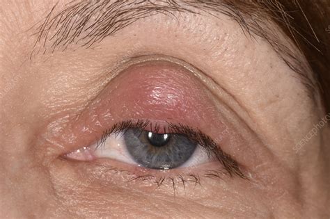 chalazion cyst   eyelid stock image  science photo