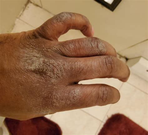 crusted scabies? : r/scabies