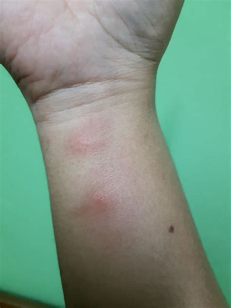 cara menghilangkan bekas gigitan nyamuk pada anak 5