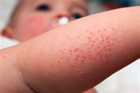 Atopiskais dermatīts – Skin.lv