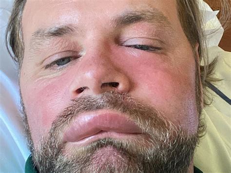 swollen face fight