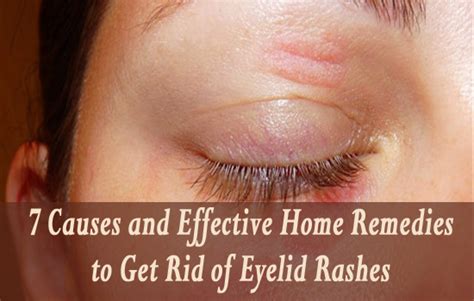 Causes And Cures Of Rashes Parents - Riset