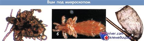 Методика обследования на наличие вшей