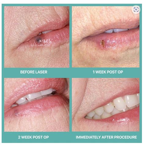atrium dental  goodbye  venous lake laser