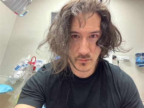 Markiplier explains why he was in hospital with red eyes