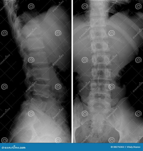 X-ray of Lumbosacral Spine, Frontal Sagital View Scoliosis Stock Image
