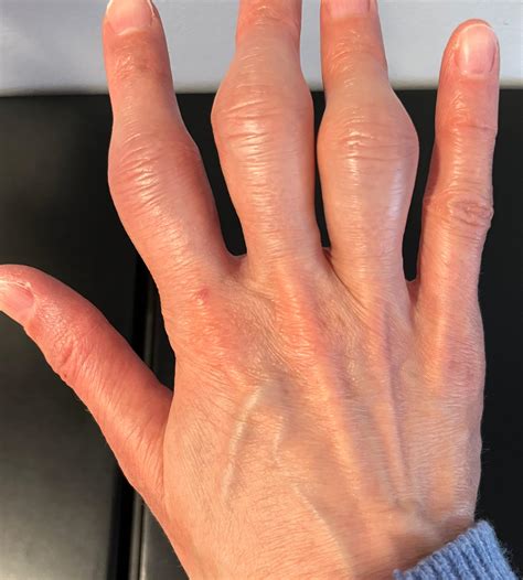 Swollen Joints